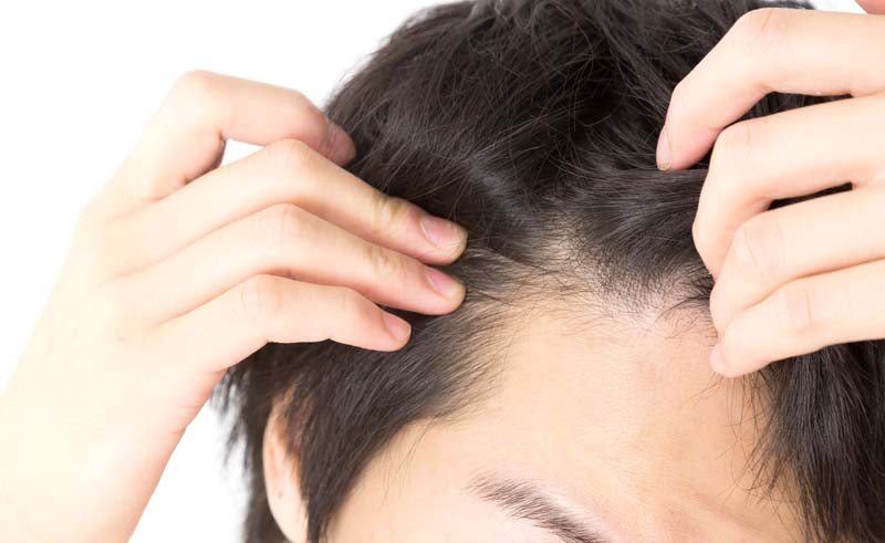 男性の生え際をアップした写真