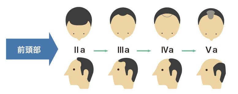 ハミルトンノーウッド分類「前頭部」 進行イメージイラスト