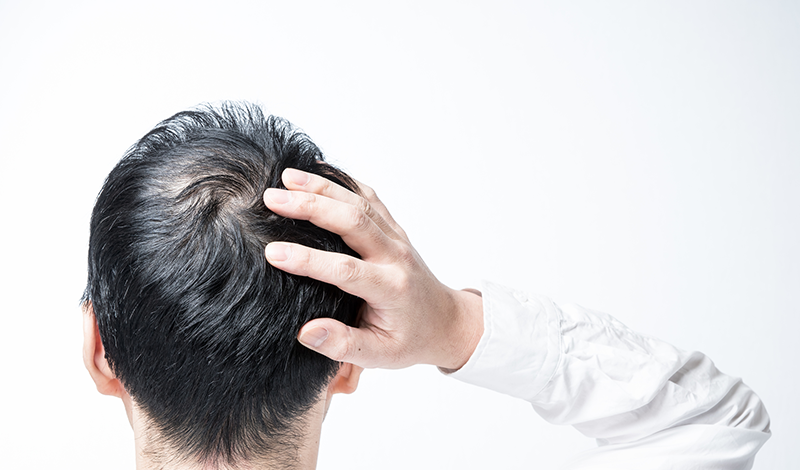 薄くなった頭頂部を触る男性