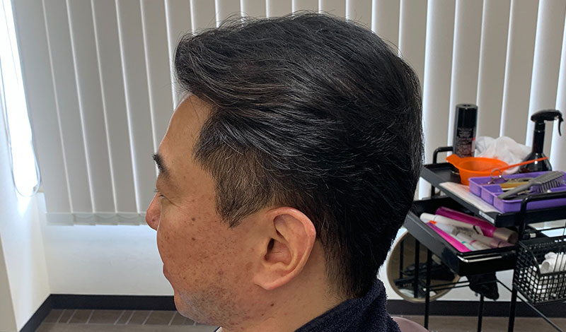 施術モデルアフター　左