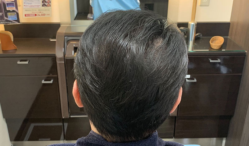 施術モデルアフター　真後ろ