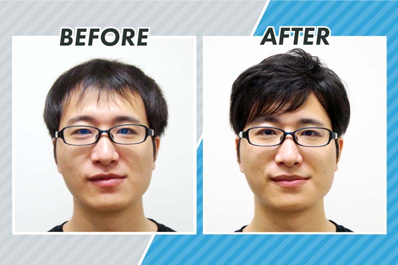 「スヴェンソン」の増髪で大変身を遂げたコクブカメラさんのビフォーアフター写真