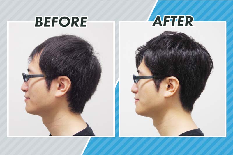 スヴェンソンの編み込み式増毛によるコクブさんのビフォーアフター写真（サイド）