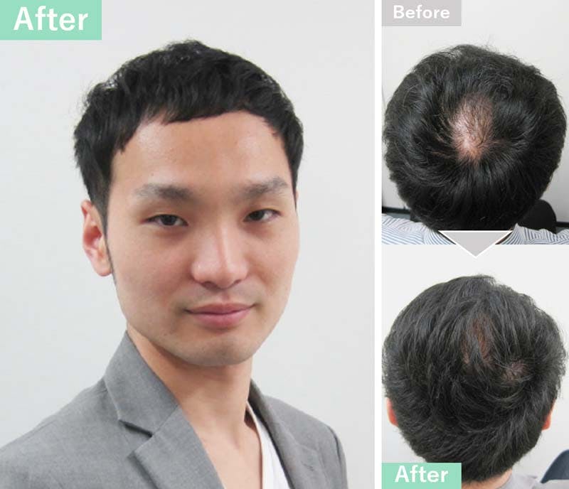 薄毛が目立たないショートヘアにセットした実例
