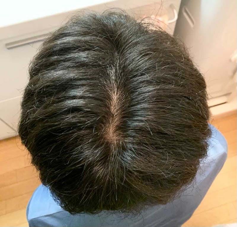 縦に割れたつむじの実例写真