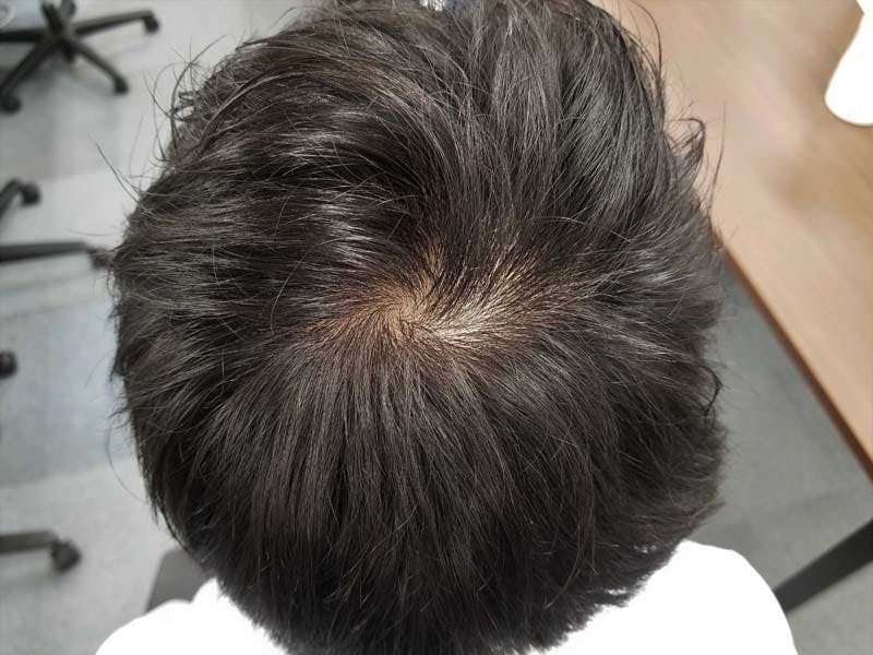 横に割れたつむじの実例写真