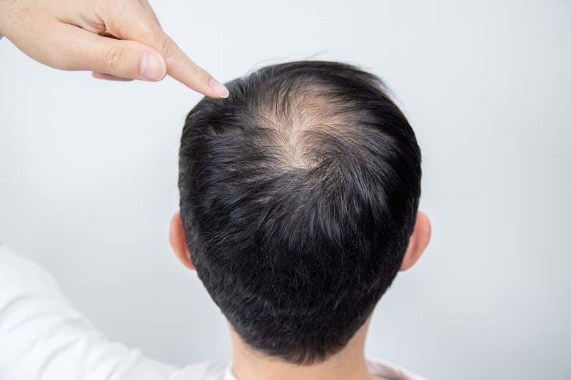 頭頂部の薄毛のイメージ画像