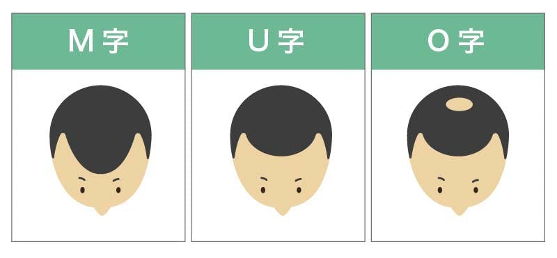 薄毛の3タイプのイメージイラスト（M字・U字・O字）