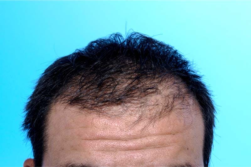 ボリュームの出ていない成人男性の頭髪のイメージ画像