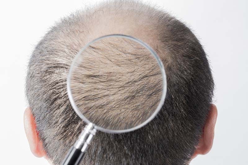 薄毛男性の後頭部のイメージ画像