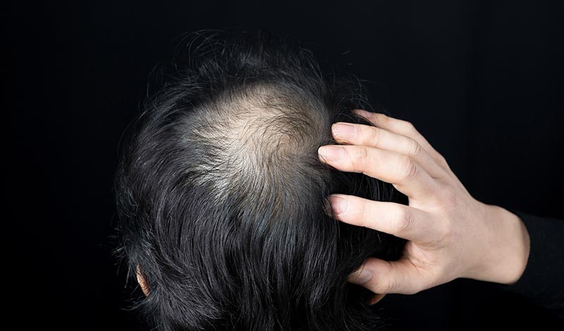 薄くなった頭頂部を触る