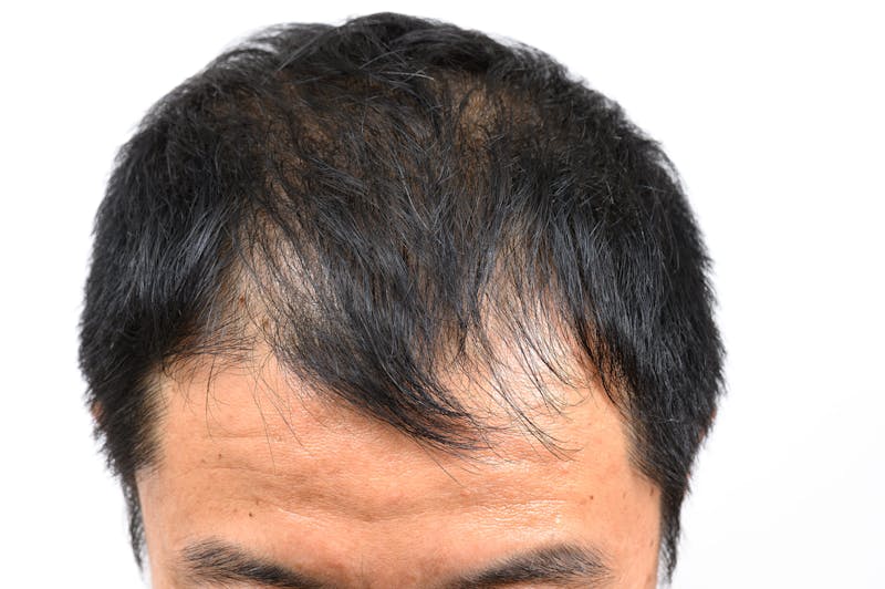 M字割れを起こした男性の頭部の見下ろしショット