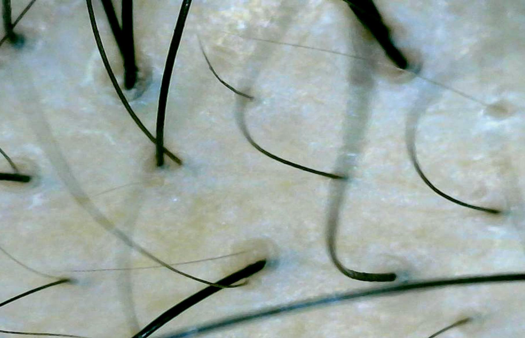 細く短い毛も見られる頭皮を写した、マイクロスコープによる拡大画像