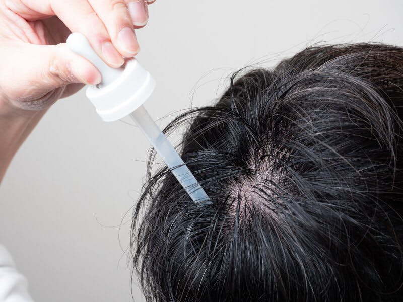 頭頂部に育毛剤を塗っている男性とその手元