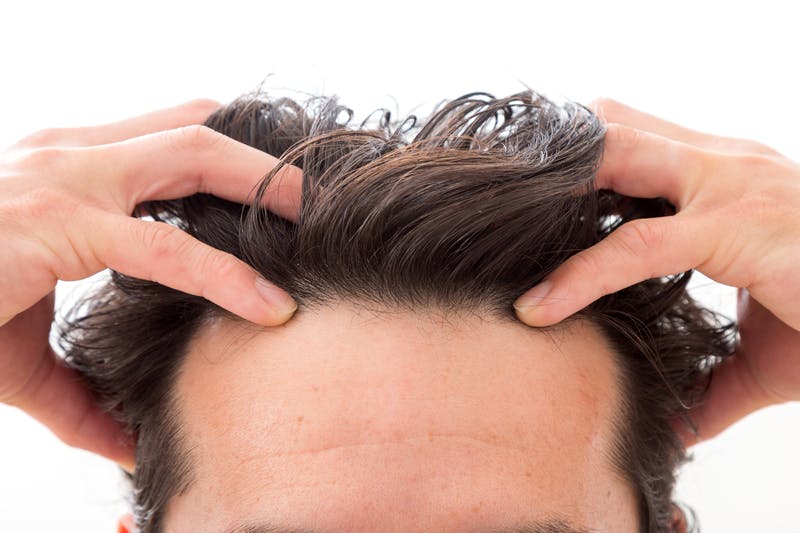 頭皮をマッサージしているM字ハゲの額