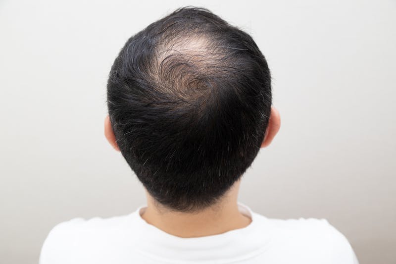 頭頂部の髪が薄くなっている男性