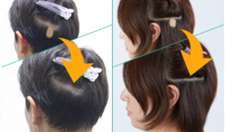 スヴェンソンの円形脱毛症ウィッグ