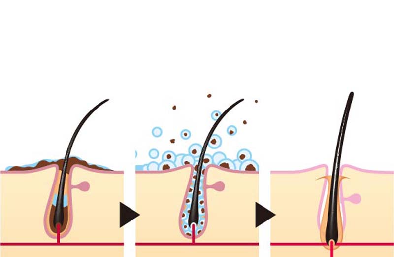 スヴェンソンの「頭皮ケア＆クレンジング」の頭皮洗浄イメージ図