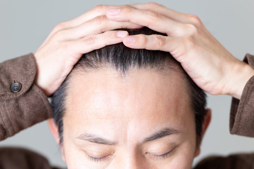 生え際の髪をかき上げて頭皮を見せる男性