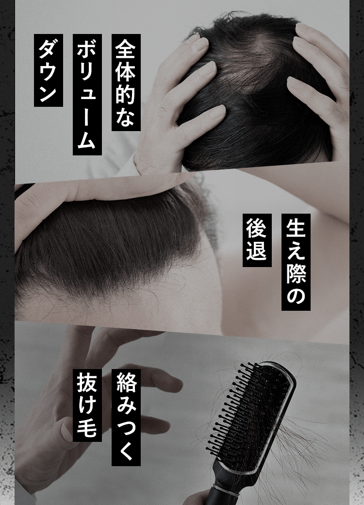 全体的なボリュームダウン・生え際の後退・絡みつく抜け毛
